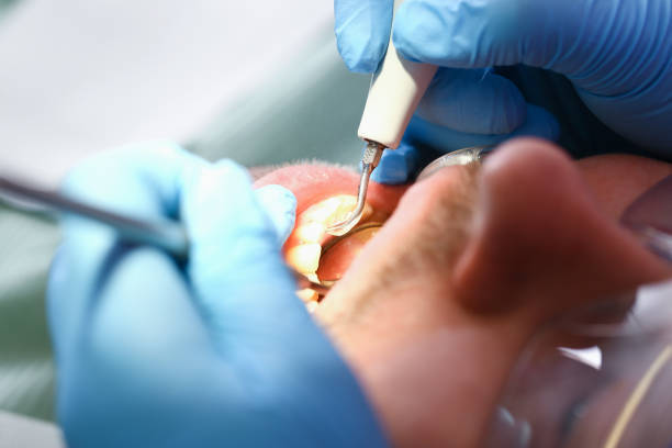 Best Emergency Dentist for Lost Fillings or Crowns in Lakeshire, MO