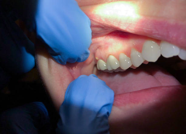 Best Emergency Dental Care for Abscessed Tooth in Lakeshire, MO